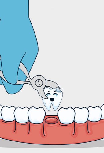 What Happens If You Leave a Broken Tooth Untreated?